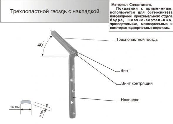 Трехлопастной гвоздь с накладкой в сборке. Компания "АРЕТЕ"